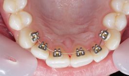 Đã Bọc Răng Sứ Có Niềng Răng Được Không? Giải đáp chi tiết
