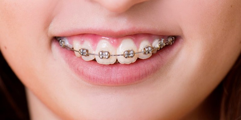 Tình trạng sai lệch khớp cắn càng nặng thì chi phí niềng răng hô hàm càng cao
