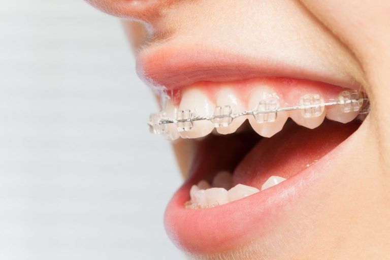 Niềng răng hô hàm trên mắc cài sứ thường có cấu tạo giống với màu răng thật