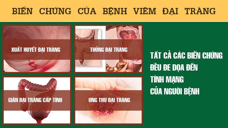 Viêm đại tràng để lâu có thể gây biến chứng ảnh hưởng đến tính mạng