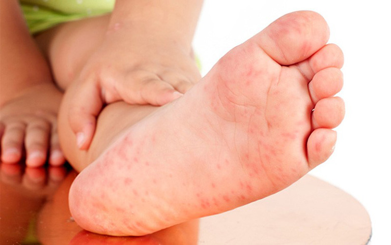 Mụn tổ đỉa ở bàn chân ảnh hưởng nhiều tới khả năng di chuyển của người bệnh