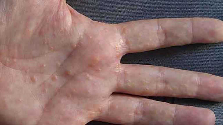 Có nhiều nguyên nhân tổ đỉa, chủ yếu liên quan đến tính nhạy cảm của da