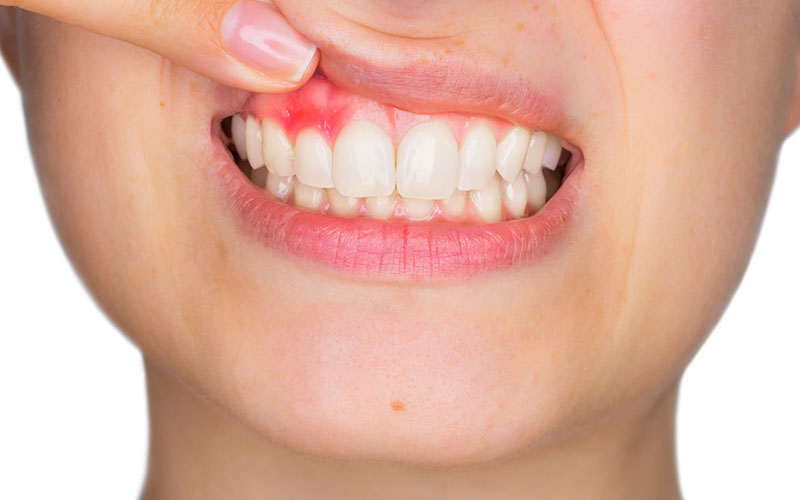 Người bị mắc các bệnh lý răng miệng, thời gian bọc răng sứ sẽ kéo dài hơn