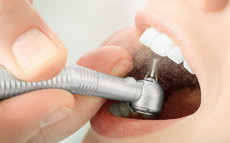 Bọc răng sứ mất bao lâu phụ thuộc vào số lượng răng cần mài