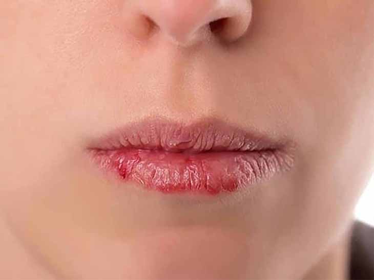 Bệnh chàm môi là gì? Có lây nhiễm không?