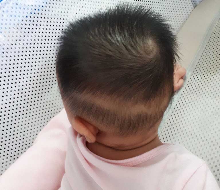 Rụng tóc vành khăn là một trong những dấu hiệu trẻ 2 tuổi thiếu canxi