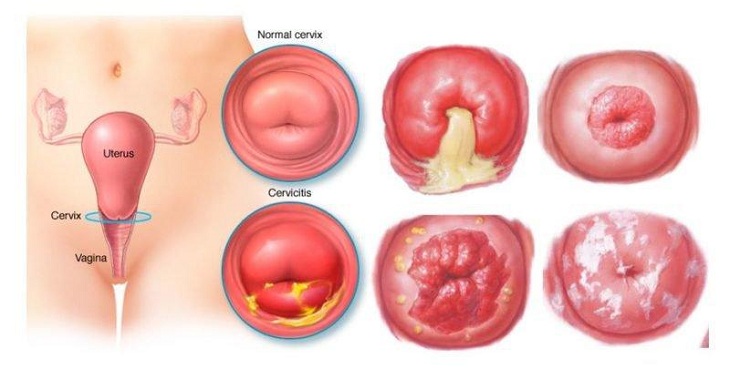 Huyết trắng ra nhiều là biểu hiện điển hình của bệnh viêm cổ tử cung