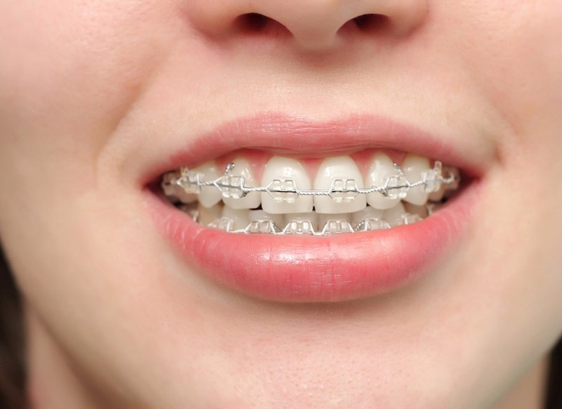 Niềng răng ở bệnh viện Răng Hàm Mặt được đánh giá có mức chi phí tương đối hợp lý