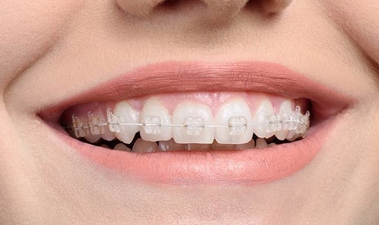 Phương pháp niềng răng sứ có nhiều ưu điểm