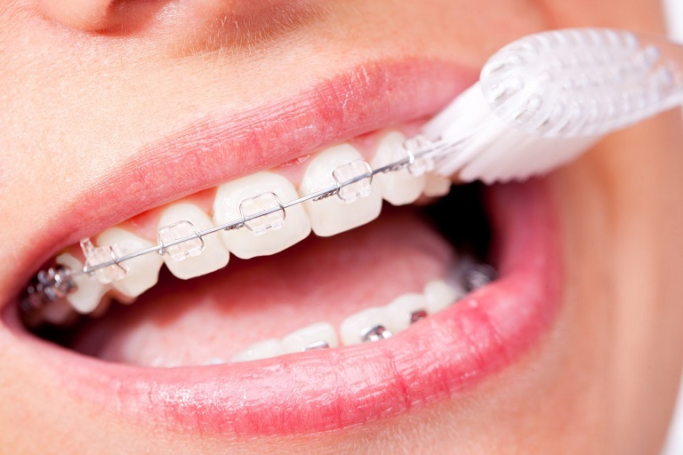 Vệ sinh răng miệng sạch sẽ trong quá trình niềng răng