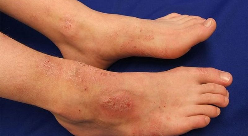 Nổi mẩn đỏ ngứa ở chân có thể do viêm da tiếp xúc