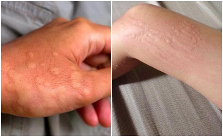 Nổi mẩn đỏ ở tay hoặc nổi mẩn đỏ ở chân có thể do nhiều nguyên nhân khác nhau