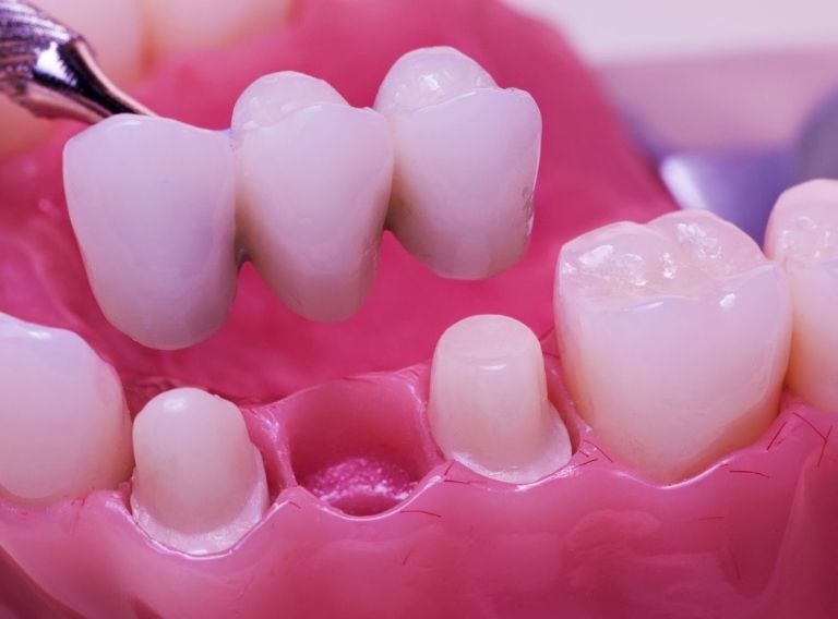 Phương pháp cầu răng sứ thường được chỉ định trong trường hợp mất một hoặc nhiều răng