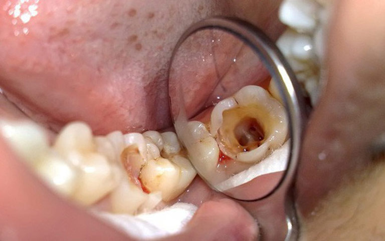 Trồng răng hàm phù hợp với những người bị sâu răng mức độ nặng
