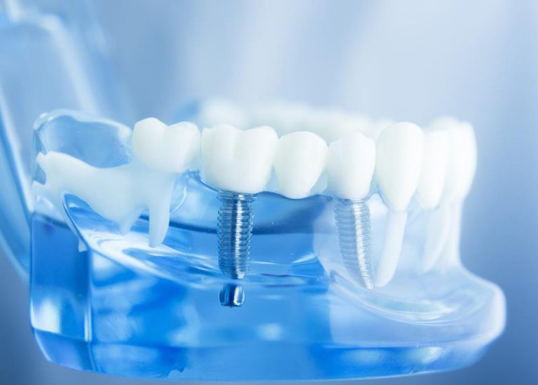Cấy ghép Implant là phương pháp trồng răng hàm được coi là hiện đại nhất hiện nay