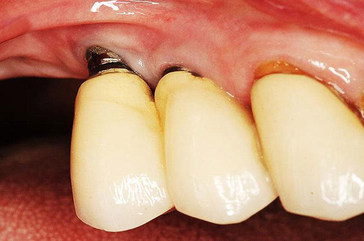 Trồng răng implant có nguy hiểm không?