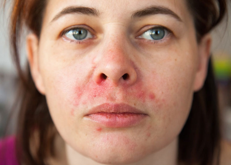Viêm da dầu ở 2 bên cánh mũi là bệnh da liễu phổ biến, xảy ra ở mọi đối tượng