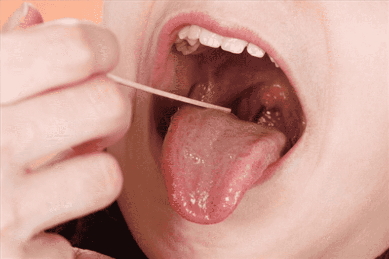 Viêm họng hạt mãn tính gây nhiều triệu chứng khó chịu 
