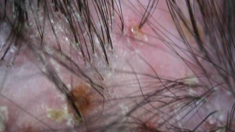 Triệu chứng viêm lỗ chân lông ở đầu