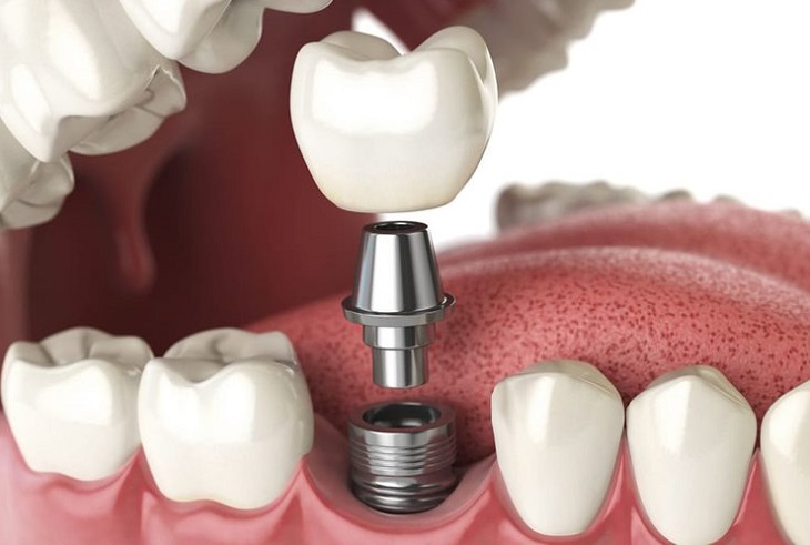 Trồng răng implant mất bao lâu do ảnh hưởng của nhiều yếu tố