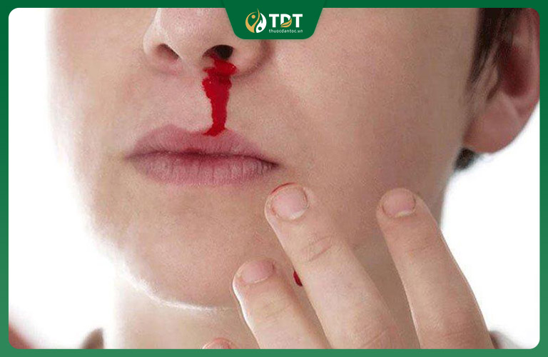 Viêm xoang chảy máu mũi là tình trạng khá phổ biến
