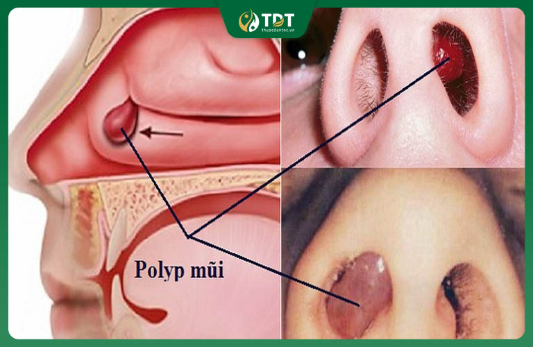 Viêm xoang polyp mũi khá phổ biến