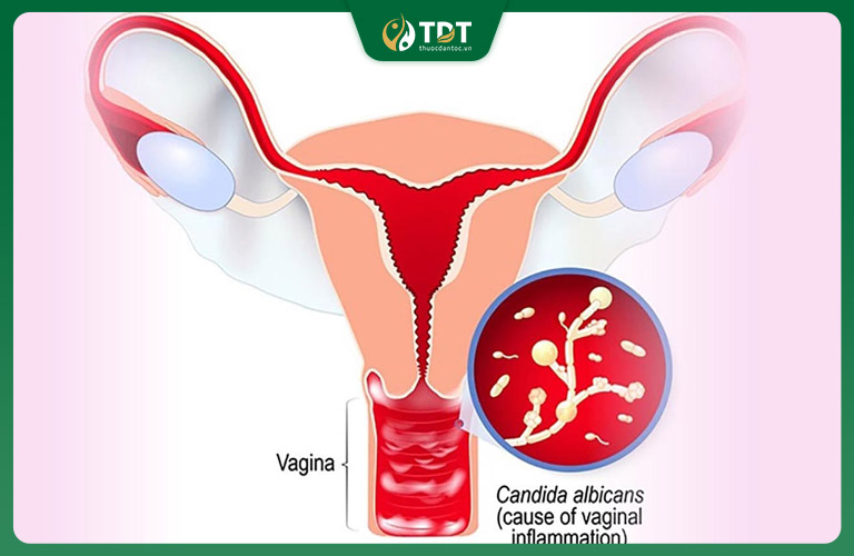 Nấm Candida vùng kín là một loại nhiễm trùng do nấm Candida albicans gây ra