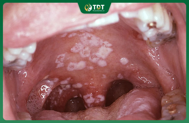 Hình ảnh người bệnh bị nhiễm nấm Candida ở miệng